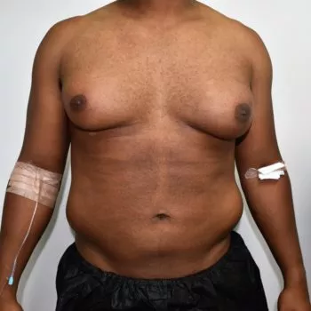 Male Breast Reduction