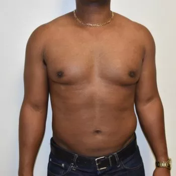 Male Breast Reduction