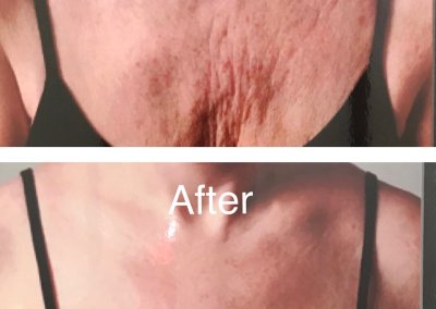 Top image: Wrinkled and loose skin on a person's neck and chest. Bottom image: Smoother and firmer skin on the same area. Both images show a person wearing a black top. Text reads "Before" and "After".