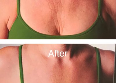 A side-by-side comparison of a woman's chest area before and after a treatment, showing reduced skin creases and a more even skin tone in the "after" image. Both images feature a green tank top.