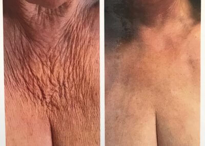 Side-by-side comparison of a chest area before and after a chest lift procedure. The left image shows significant wrinkling and the right image shows smoother, rejuvenated skin. Text below reads "Chestlift #1.