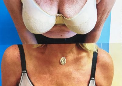 Comparison images showing a person's chest before (top) and after (bottom) a chest lift procedure. The text "Chestlift #2" appears below the after image.