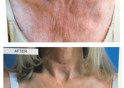 Comparison of a person's chest before and after a cosmetic chest lift treatment. The "Before" image shows wrinkled skin, while the "After" image shows smoother, tighter skin. Labeled "Chestlift #3.