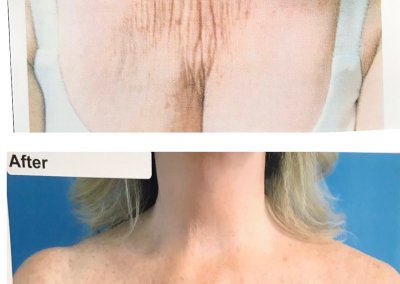 Before and after images showing the results of a cosmetic chest lift procedure. The "Before" image displays prominent wrinkles and sagging skin, while the "After" image shows smoother, firmer skin.