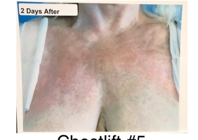 A three-image series shows chest skin before a lift, two days after, and 23 days after the procedure. Improvements in skin appearance and reduction in wrinkles are evident in the later images.