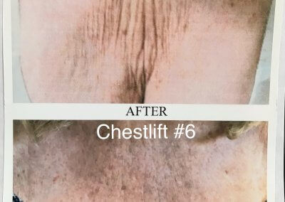 Before and after image of a chest showing skin improvement post-procedure called Chestlift #6, illustrating reduced wrinkles and tighter skin.